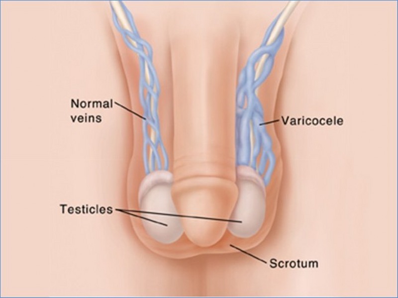 Cos’è il varicocele 