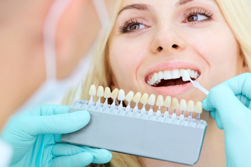 Sbiancamento dentale, l’importanza di avere un sorriso brillante